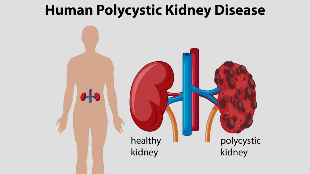 polycystic-kidney-disease-causes-and-symptoms-onlymyhealth