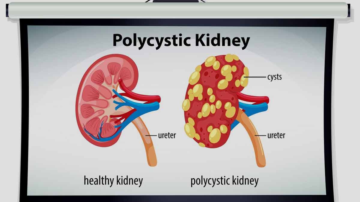 Polycystic Kidney Disease: Causes and Symptoms