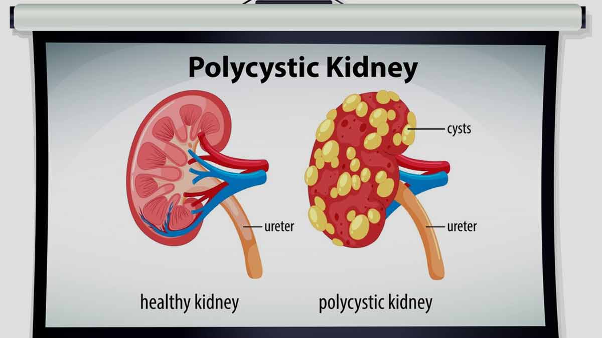 effective-natural-treatment-for-polycystic-kidney-disease-pkd-in