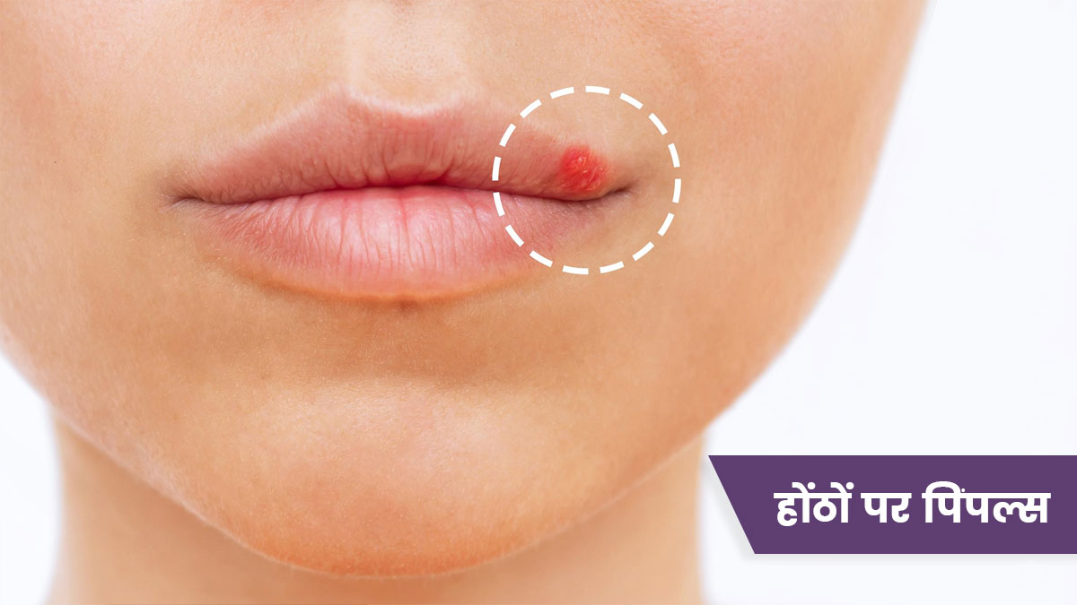 होंठों के पिंपल्स और फुंसियों को दूर करने के लिए अपनाएं ये 5 टिप्स