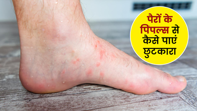 पैरों के पिंपल्स को कैसे हटाएं? जानें असरदार घरेलू उपाय