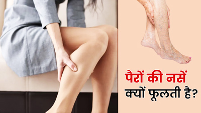 Nerve Swelling in Leg: पैरों की नसें क्यों फूलती हैं? जानें 7 कारण