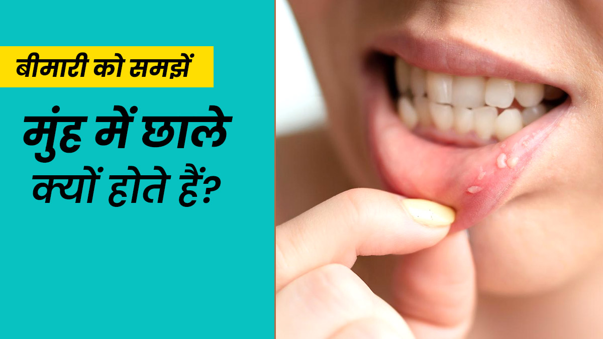 Mouth Ulcers: मुंह में छाले क्यों होते हैं? डॉक्टर से समझें इसके कारण