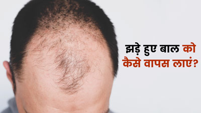 झड़ गए हैं सिर के आधे से ज्यादा बाल? तो इन 5 उपायों से उगाएं