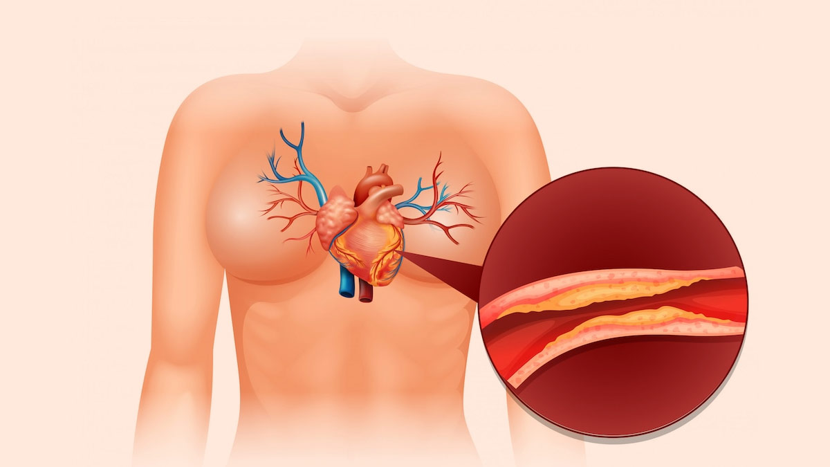 High Cholesterol Causes Reasons In Hindi