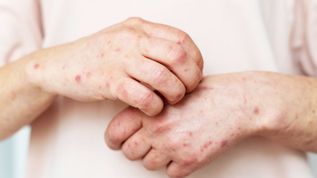 itching treatment in hindi 