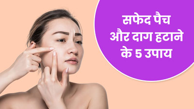 चेहरे पर सफेद दाग और पैच मिटाएंगे ये 5 घरेलू उपाय