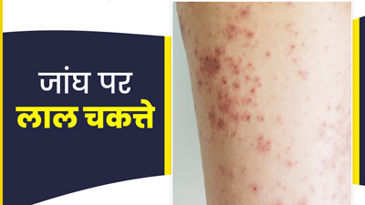 जांघों पर लाल चकत्ते हो सकते हैं फंगल इंफेक्शन, जानें इनके घरेलू उपाय
