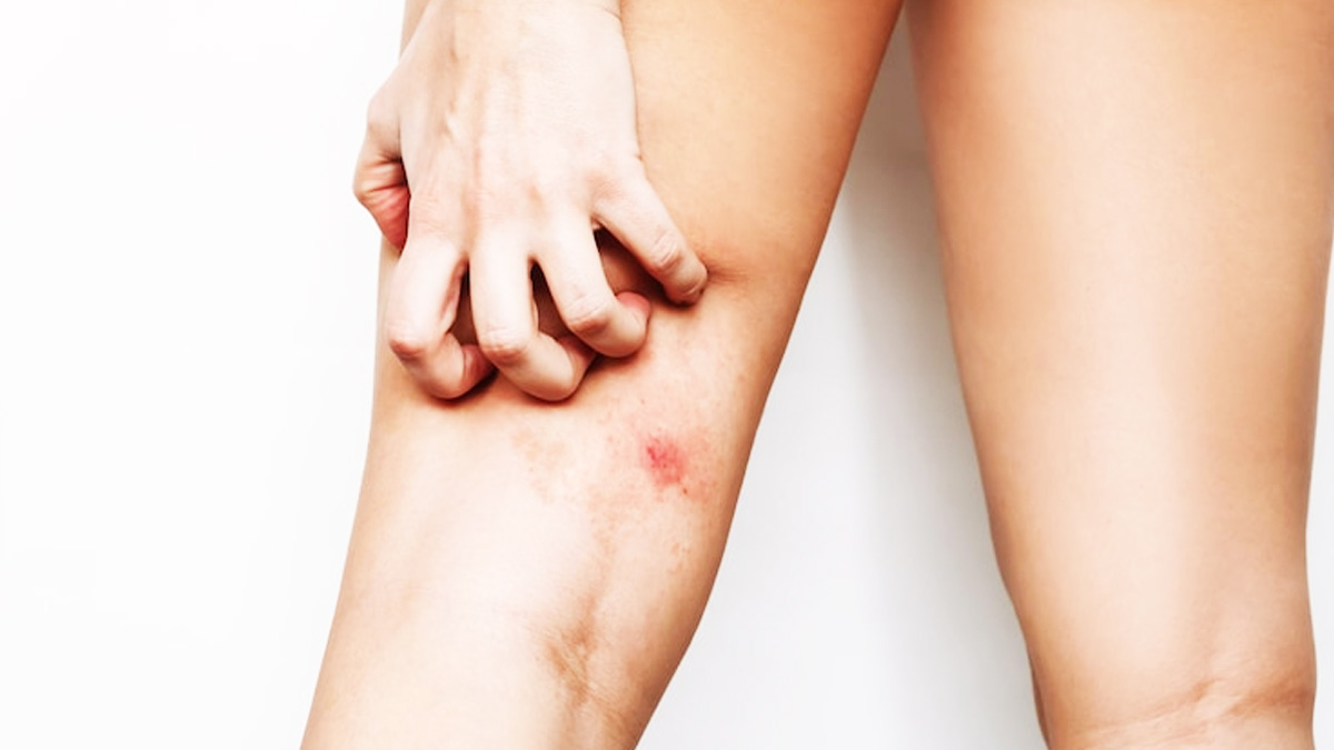 red rashes on thighs 