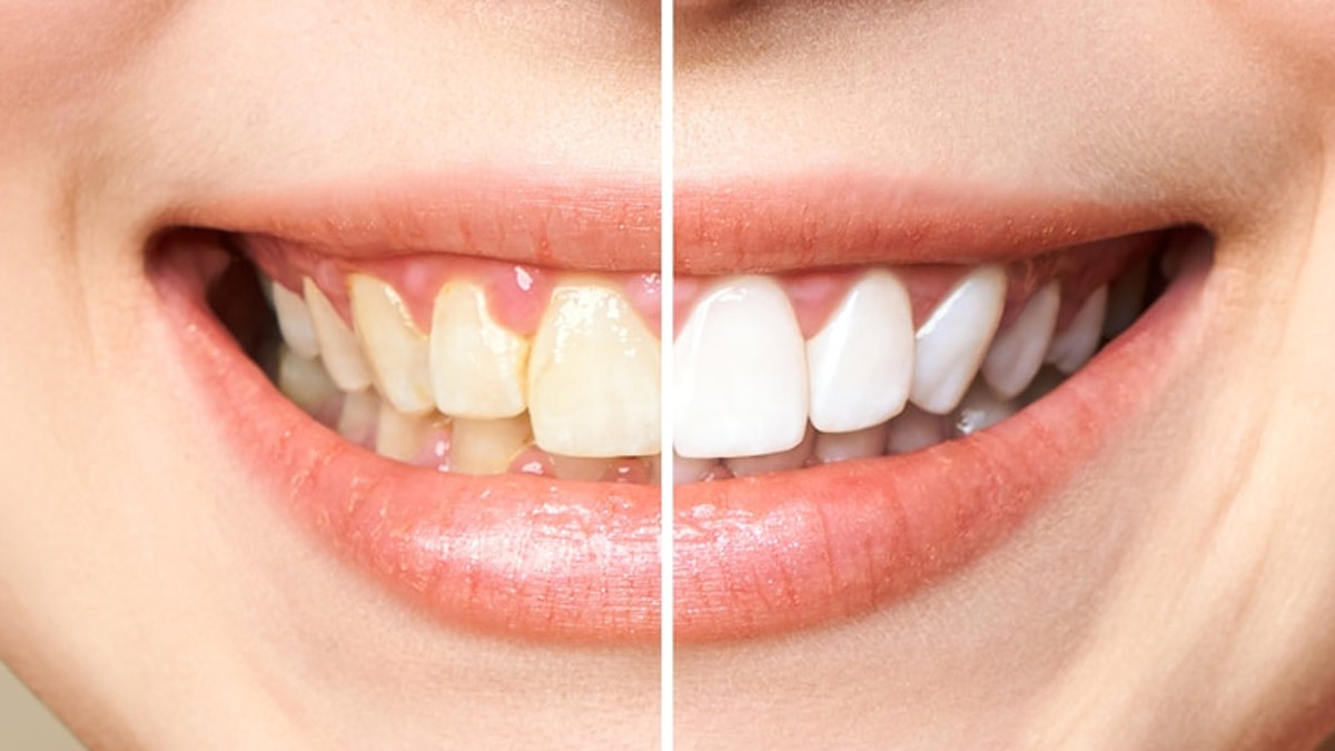 yellow teeth treatment 