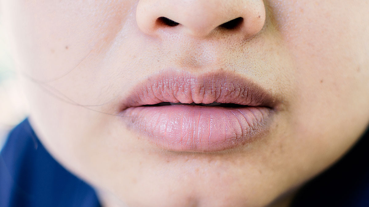 होंठ के ऊपरी हिस्से (अपर ल‍िप्‍स) का कालापन दूर करने के लिए आजमाएं ये 5 घरेलू उपाय