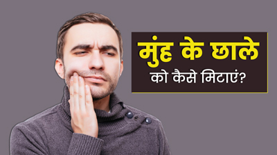 Mouth Ulcer Home Remedies: मुंह के छाले कैसे मिटाएं? एक्सपर्ट से जानें आयुर्वेदिक इलाज
