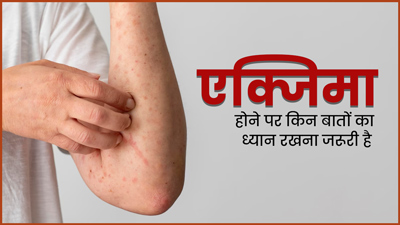 एक्जिमा होने पर रखें इन 5 बातों का ध्यान, समस्या होगी कम