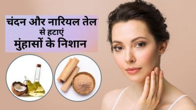 नारियल तेल और चंदन पाउडर के इस्तेमाल से हटाएं मुंहासों के दाग, जानें तरीका