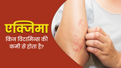शरीर में इन 4 विटामिन्स की कमी से हो सकता है एक्जिमा रोग, डाइट में जरूर करें शामिल