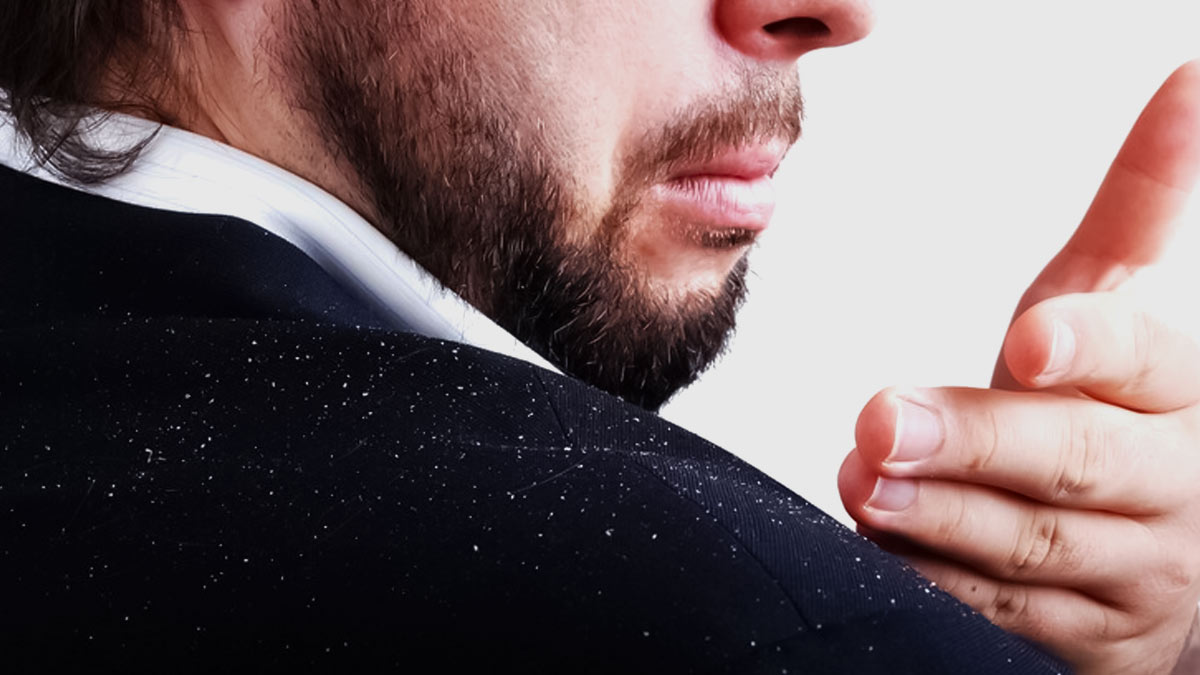 5 Reasons Why You Are Susceptible To Dandruff