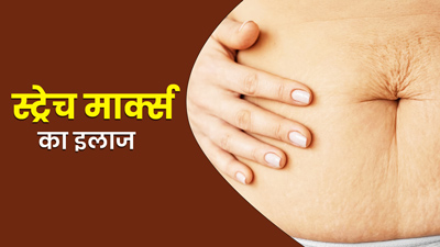 पुराने और जिद्दी स्ट्रेच मार्क्स को कम करने में फायदेमंद है हल्‍दी, जानें इस्‍तेमाल का तरीका