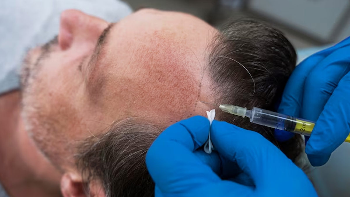 Hair Loss In Men