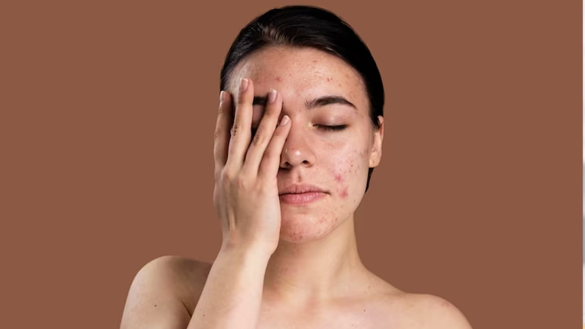 From Over-Exfoliating To  Popping Acne: Here're 8 Skincare Habits That Can Worsen Your Acne