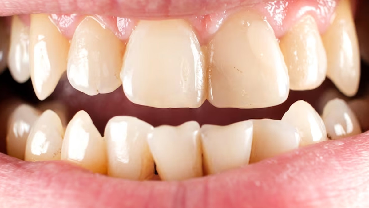 Natural Remedies For Removing Tartar Buildup From Teeth