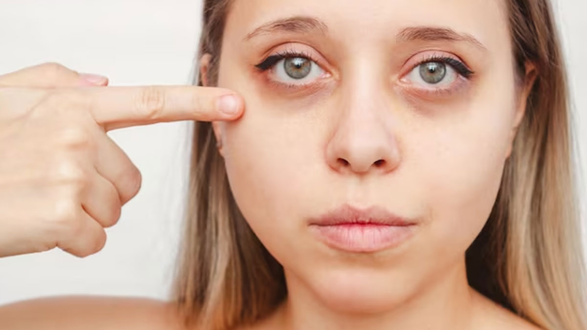 Under Eye Bags: Reasons And Treatment One Should Know