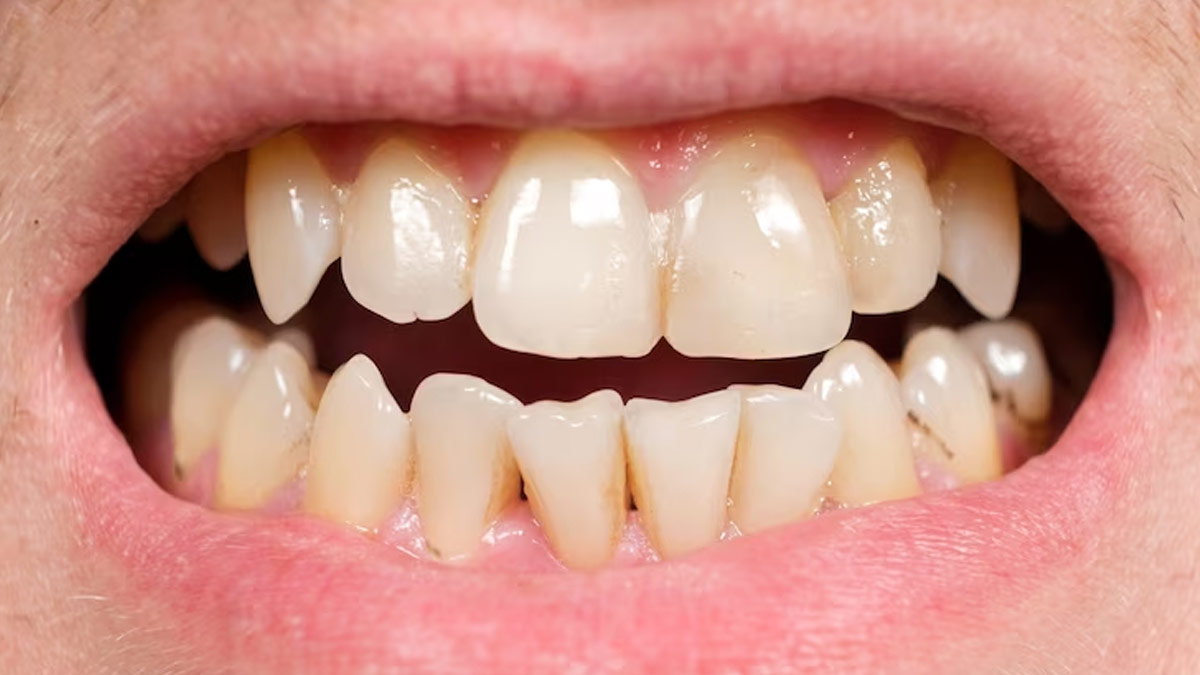 What Color Is Tartar On Your Teeth at Jenny Nichole blog