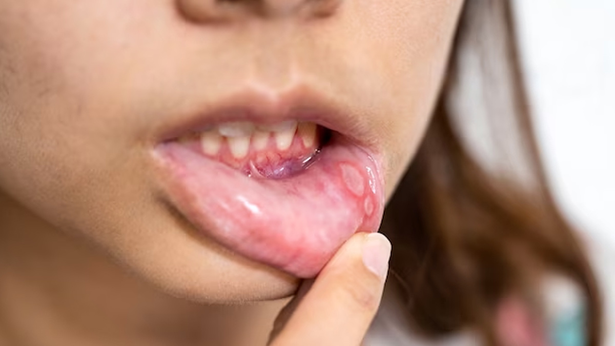 Poppy Seeds Benefits For Mouth Ulcers in Hindi