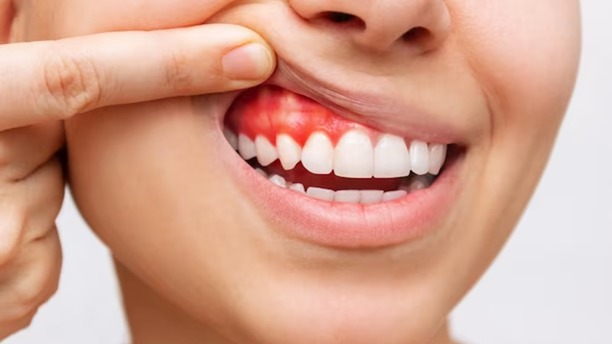 what diseases can you get from kissing in hindi