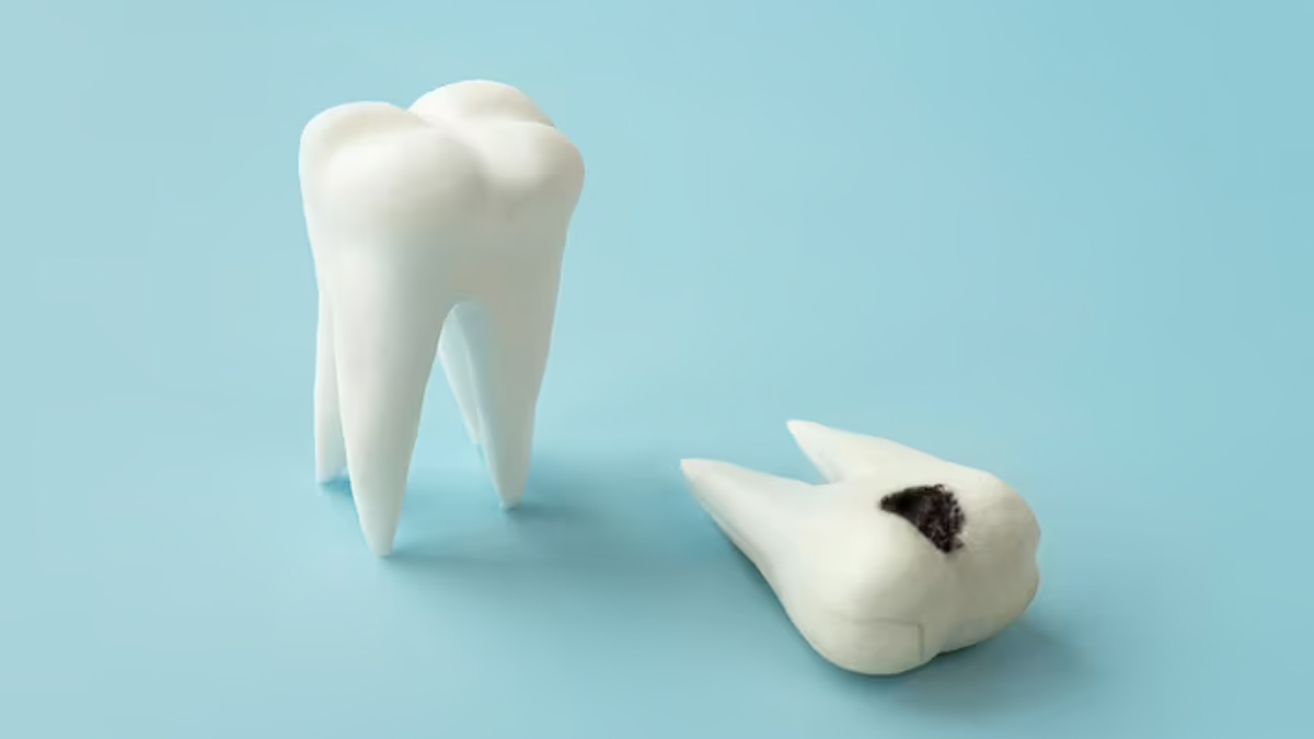 Cracked Tooth Syndrome: Causes, Symptoms, Prevention