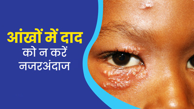 आंख में होने वाले दाद (शिंगल्‍स) को न करें नजरअंदाज, बढ़ सकती है परेशानी 