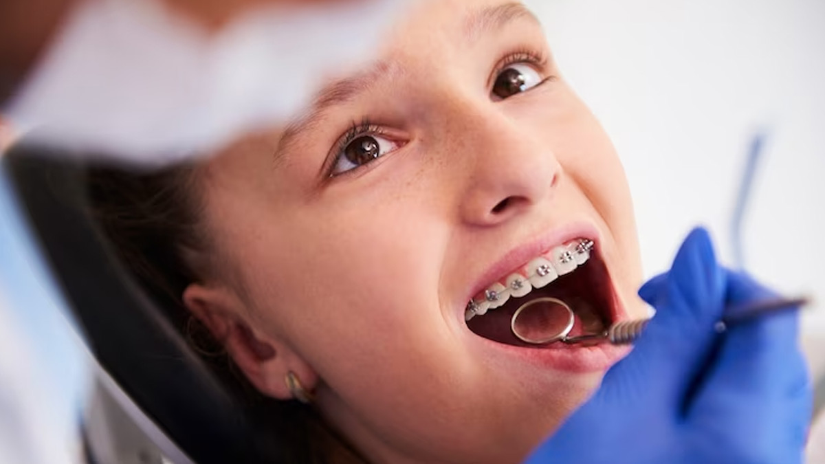 Dental Hygiene For People Wearing Braces: Expert Lists Measures To Maintain Hygiene