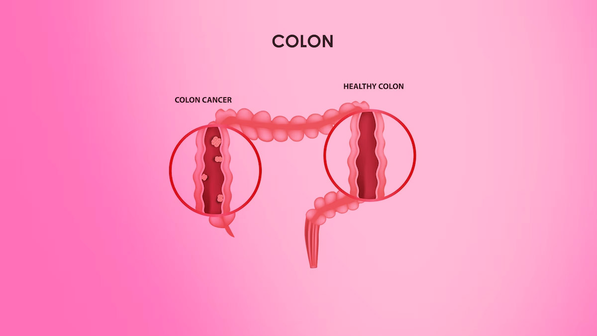 colon cancer risk