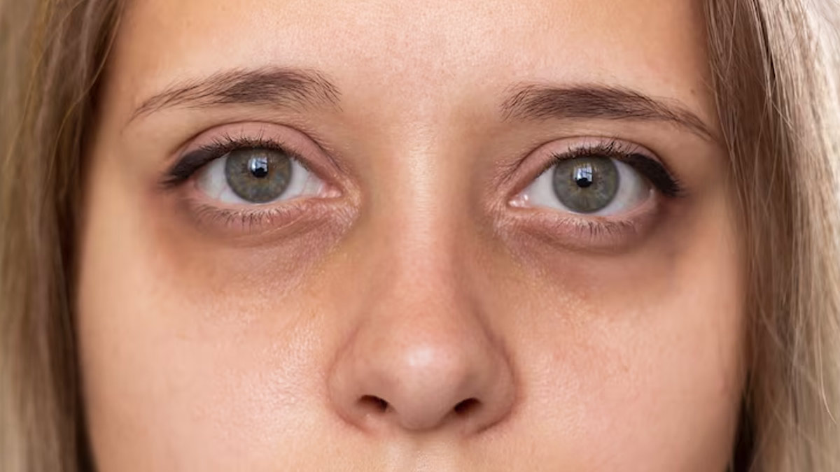 Causes of Puffy Eye, eye stye, thyroid eye disease