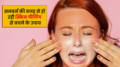 सनबर्न (Sunburn) की वजह से स्किन से निकल रही हैं पपड़ियां, इन 4  उपायों से पाएं छुटकारा