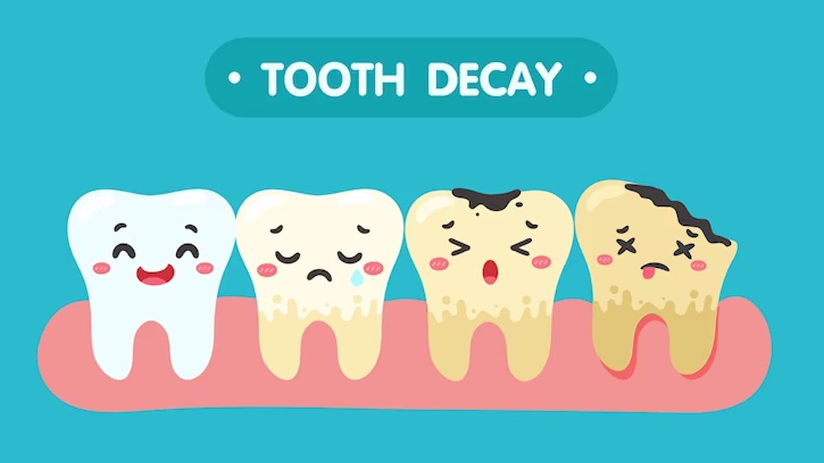 Tooth Decay: Here's How You Can Reverse It Easy Ways