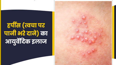 हर्पीस (त्वचा पर पानी भरे दाने) को ठीक करने के लिए 5 आयुर्वेदिक उपाय