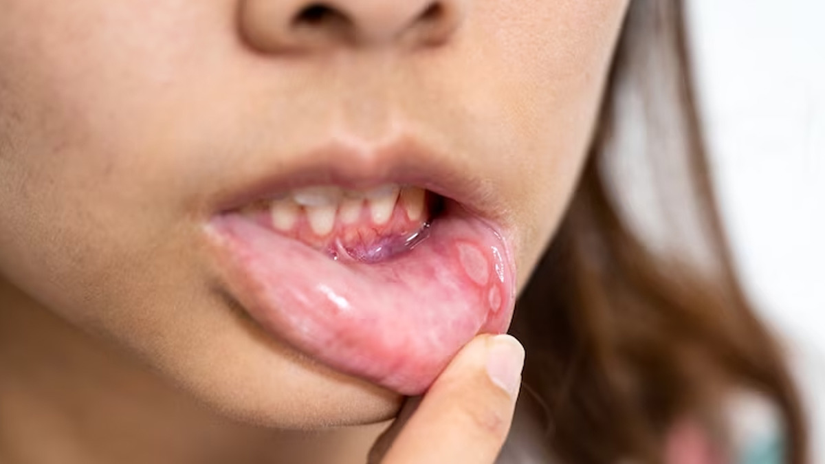 Expert Explains Causes And Treatment Of Mouth Ulcers In Children