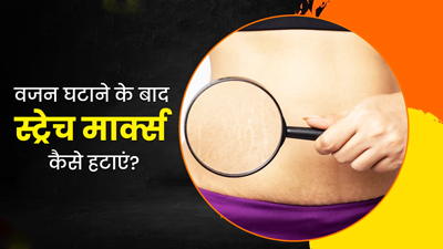 वेट लॉस के बाद दिख रहे हैं स्ट्रेच मार्क्स? छुटकारा पाने के लिए आजमाएं ये 5 घरेलू उपाय