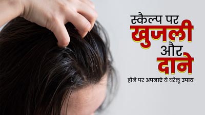 स्कैल्प पर खुजली और दाने होने पर अपनाएं ये घरेलू उपाय, समस्या से मिलेगा जल्द छुटकारा 