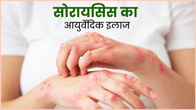 सोरायसिस से छुटकारा पाने के लिए आजमाएं ये 5 आयुर्वेदिक उपाय, जल्द मिलेगा आराम