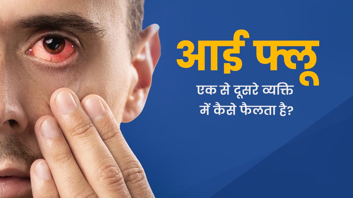 Eye Flu: आई फ्लू एक से दूसरे व्यक्ति में कैसे फैलता है? जानें इससे बचने के तरीके