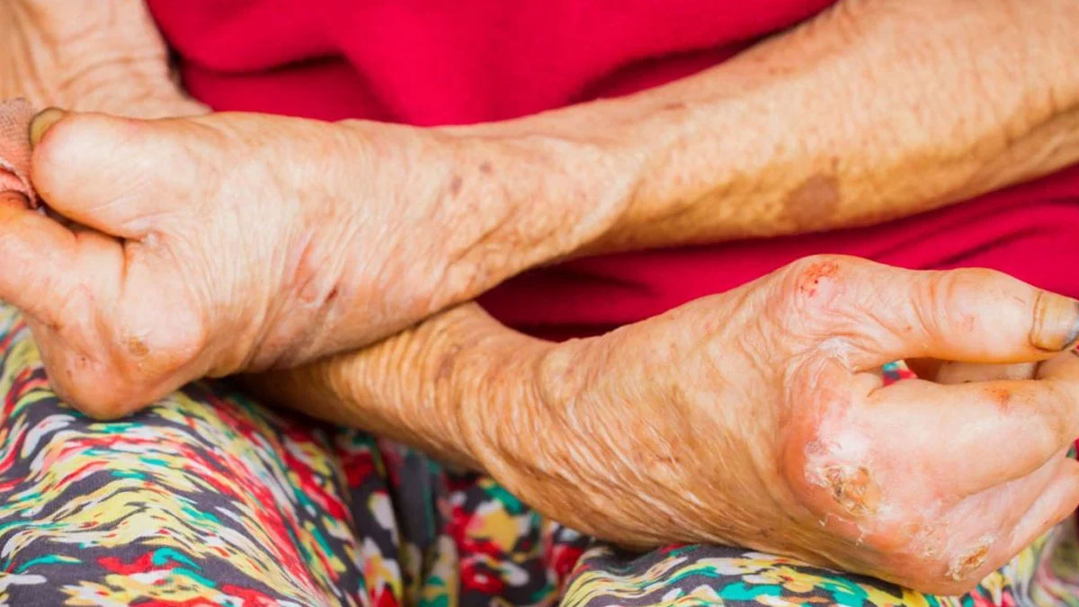 liprosy