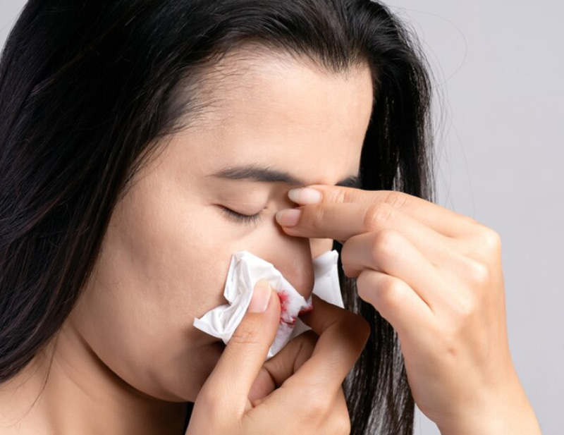 nose bleed