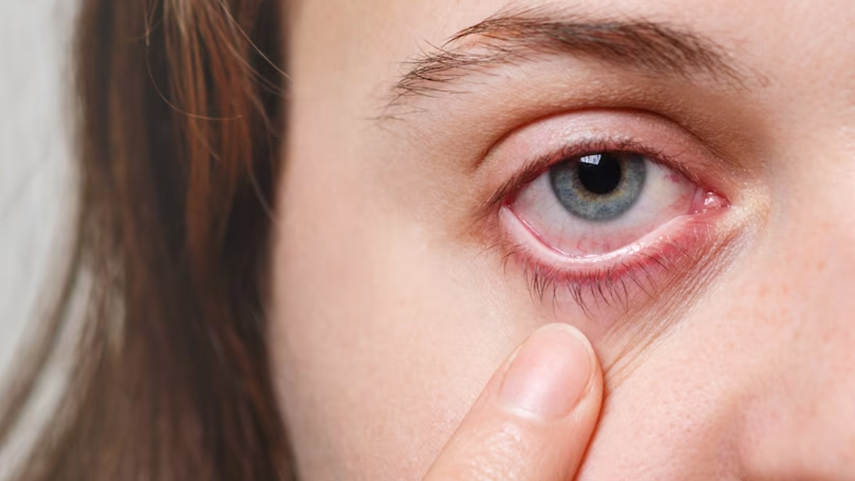 Swollen Eyes From Flu Causes And Remedies in hindi