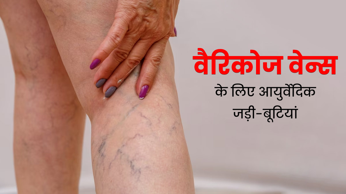 वैरिकोज वेन्स की समस्या को कम कर सकती हैं ये आयुर्वेदिक जड़ी-बूटियां, जानें प्रयोग का तरीका