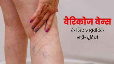 वैरिकोज वेन्स की समस्या को कम कर सकती हैं ये आयुर्वेदिक जड़ी-बूटियां, जानें प्रयोग का तरीका