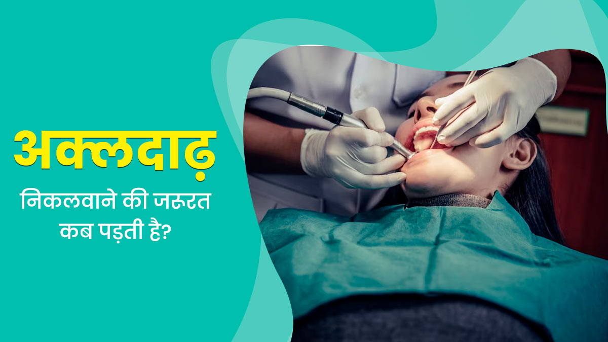 इन 5 परिस्थितियों में पड़ती है अक्लदाढ़ निकलवाने की जरूरत, न करें अनदेखी
