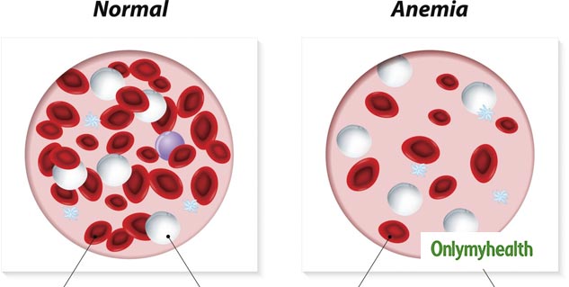 1 in 4 People Have Anaemia Worldwide, Rates Fall Only For Men: Lancet Study