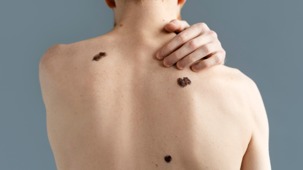 melanoma causes and treatment in hindi 