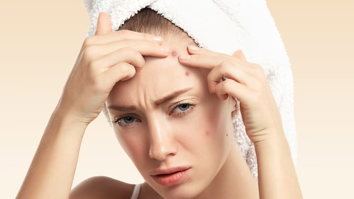 Pimples on Forehead: माथे पर बार-बार निकल आते हैं मुहांसे? छुटकारा पाने के लिए आजमाएं ये खास टिप्स 